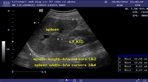 Normal Spleen Ultrasound