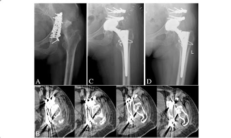 Delayed total hip arthroplasty (THA) in a 51-year-old woman with ...