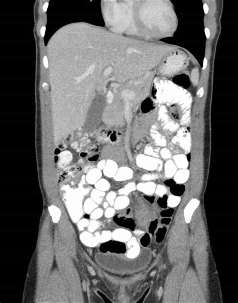 Abdomen / Pelvis CT Scan: St. Elizabeth's Medical Center | Steward Family Hospital | Brighton MA