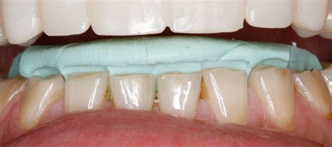 Direct Composite for Repairing Worn Incisal Edges - Lee Ann Brady DMD