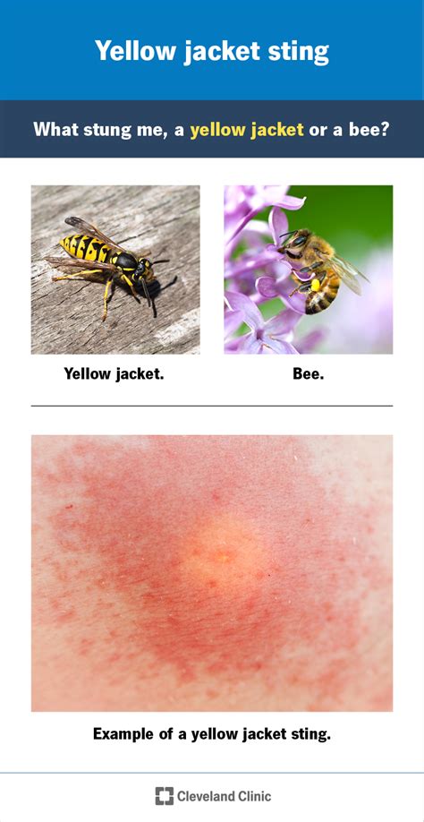 Yellow Jacket Sting: Symptoms & Treatment