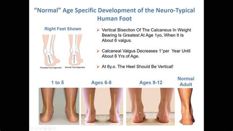 Treating Common Foot Conditions in Teens to Adults with Down Syndrome | Down syndrome, Syndrome ...