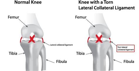 Pin on Knees: Knee Exercises, Knee Injuries & Knee Treatment