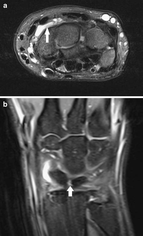 Small dorsal ganglion cyst. a Axial FS T2-WI. Note a well-delineated ...