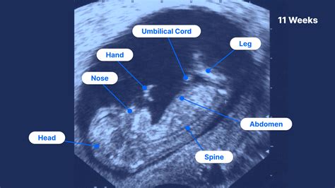 11-Week Ultrasound: Pictures, Fetus Size & What to Expect