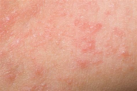 What is scabies? Everything you need to know about scabies rash.