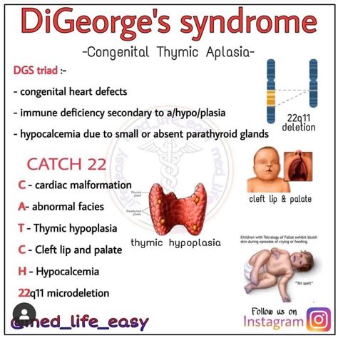 Di george syndrome - MEDizzy