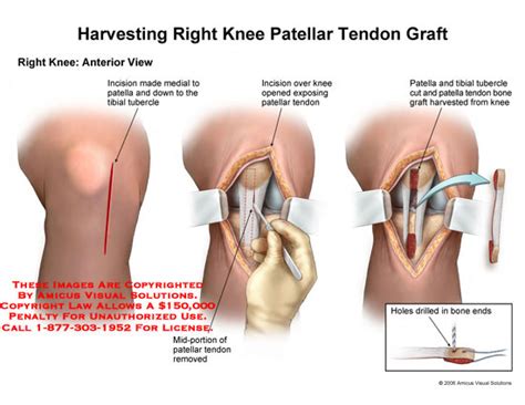 AMICUS Illustration of amicus,surgery,knee,repair,patellar,tendon,graft,harvest,excised,tubercle