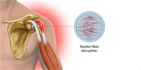 Mouse shoulder: a painful overuse injury for PC gamers – Esports Healthcare Bicep Tendonitis ...