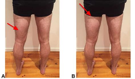 Hamstring Injury - Causes, Symptoms, Recovery Time & Treatment