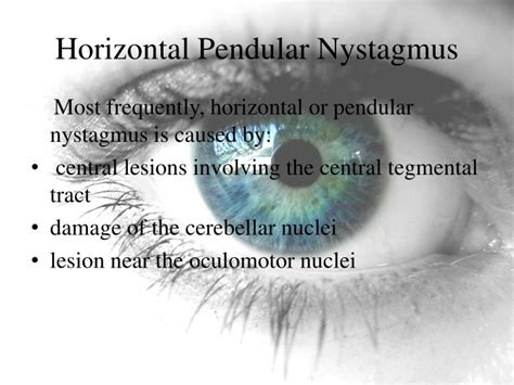 PPT - Nystagmus PowerPoint Presentation - ID:1852222