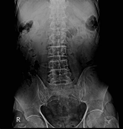 The Diagnosis and Management of Recurrent Gallstone Ileus: A Case Report | Cureus