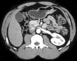 Malrotated Right Kidney - Kidney Case Studies - CTisus CT Scanning