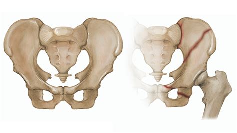 Pelvic Fractures - Hughston Clinic