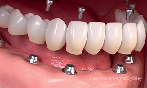 Full Mouth Dental Implants — Paramount Dental Sydney