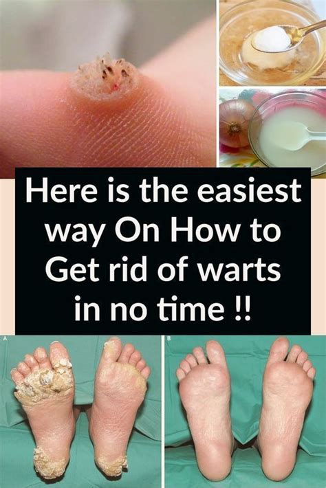 Here is the easiest way On How to Get rid of warts in no time ...