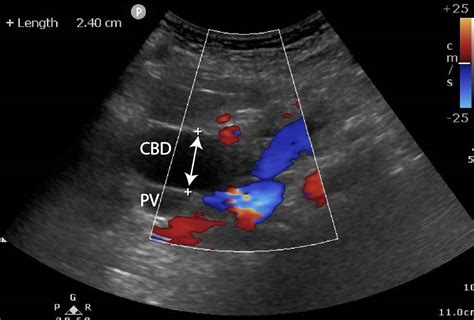 Dilated CBD, pancreatic carcinoma - Critical Care Sonography