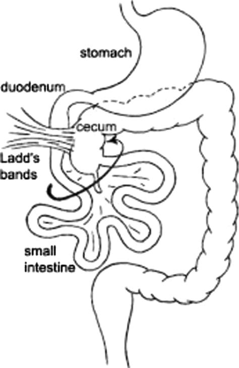 Depiction of the Ladd's band caused by bowel malrotation. | Download Scientific Diagram