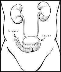 Different Types of Urostomy Surgery | Surgery, Peace gesture, Pouch