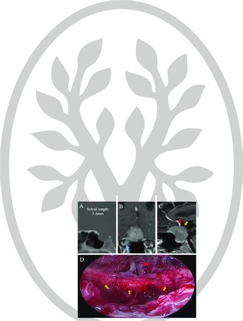 Case demonstration of type B tuberculum sellae meningioma: (A): CT scan ...