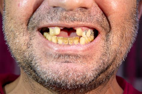 Toothless Man Smiling Man With Yellowed Teeth Stock Photo - Download Image Now - iStock