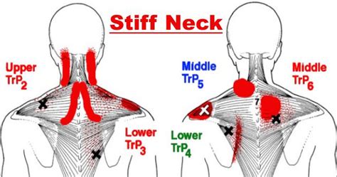 How to Treat Stiff Neck In One Minute (or Less): Detailed Instructions