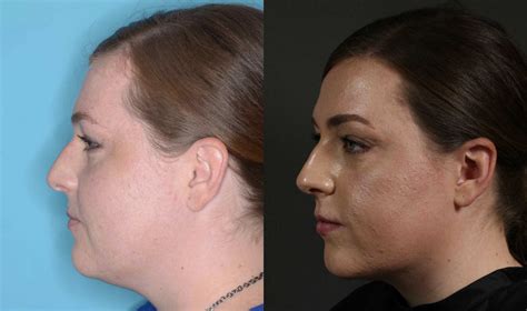 How to Lose Chin & Jaw Fat With Kybella | Timeless Skin Solutions