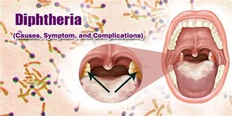 Diphtheria (Causes, Symptom, and Complications) - Assignment Point