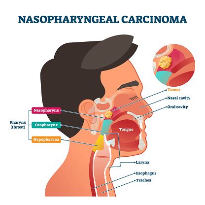 Nasopharyngeal Carcinoma Tumor Vector Illustration Stock Illustration ...