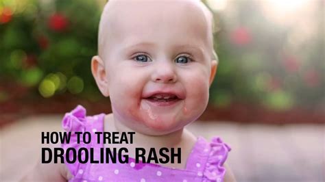 11 Natural Ways to Treat Drool Rash in Babies | Teething rash on face, Baby rash on face ...