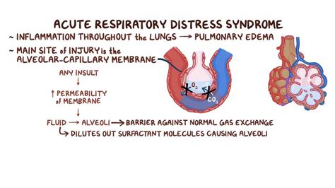 Causes Of Acute Respiratory Distress Syndrome Ards Medical Estudy - Bank2home.com