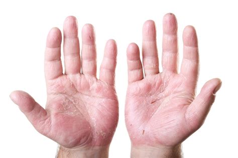 Hand Eczema: Causes, Symptoms and Treatment Options