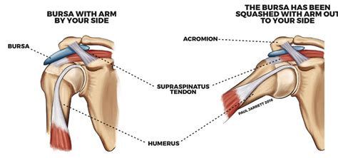 Impingement & Bursitis - Dr Paul Jarrett, Shoulder Specialist & Surgeon