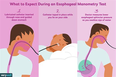 Esophageal Manometry Test: Uses, Side Effects, Procedure, Results