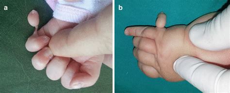 Polydactyly | SpringerLink