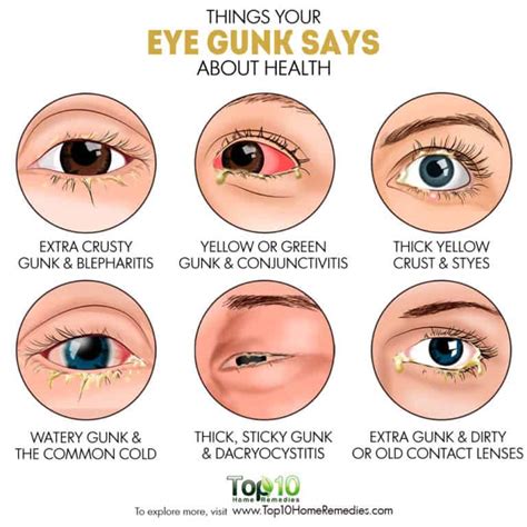 Things Your Eye Gunk Says about Health | Top 10 Home Remedies