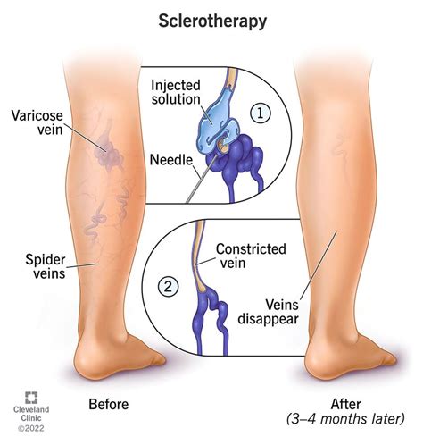 Sclerotherapy: Treatment for Varicose and Spider Veins