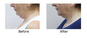 Cryolipolysis / fat freezing treatment of the chin - ICE AESTHETIC