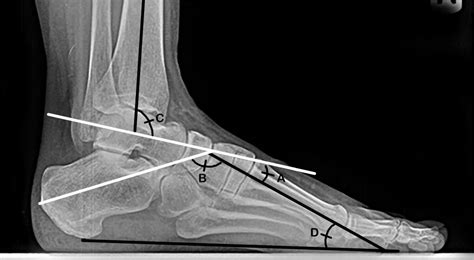 Imaging of the Pes Cavus Deformity - Clinics in Podiatric Medicine and Surgery