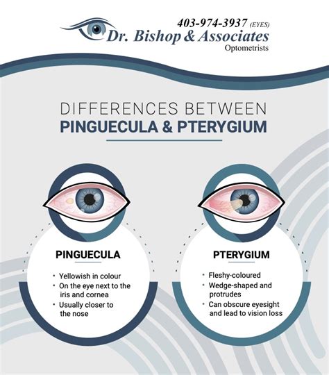 Pinguecula And Pterygium Symptoms Causes Prevention Surgery | Hot Sex ...