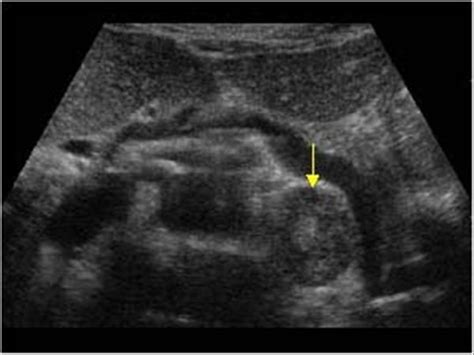 Abdomen and retroperitoneum | 1.10 Adrenal glands : Case 1.10.3 ...