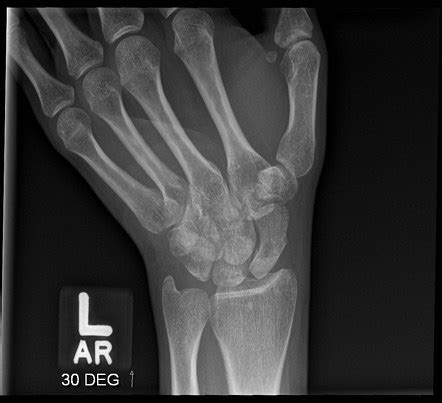 Scaphoid Fracture Avascular Necrosis