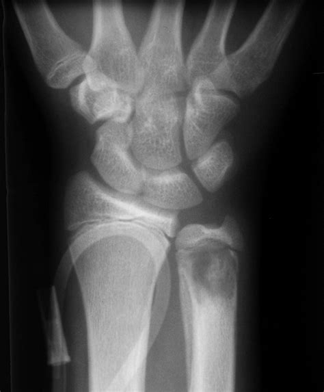 Imaging Manifestations of Blastomycosis: A Pulmonary Infection with ...