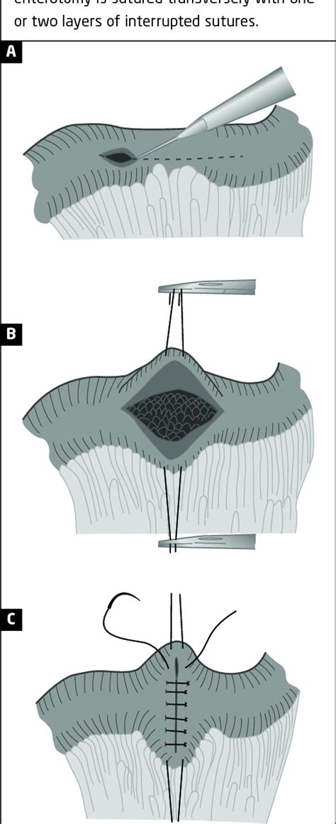 Heineke-Mikulicz strictureplasty. | Download Scientific Diagram