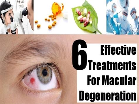 6 Effective Treatments For Macular degeneration