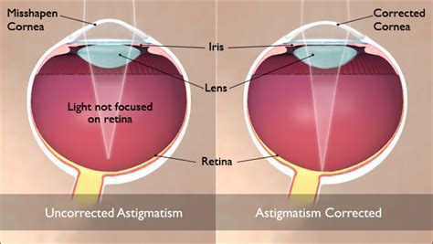 What Is Astigmatism and How to Fix It: Guides and Videos