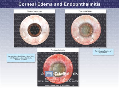 Corneal Edema and Endophthalmitis - TrialQuest Inc.