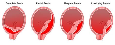 Que é a placenta?