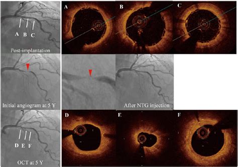 In-scaffold vasospastic angina at 5 years, in a 78-year-old man who had ...