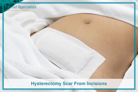 Hysterectomy Scar From Incisions (Pictures) | Fibroid Specialists